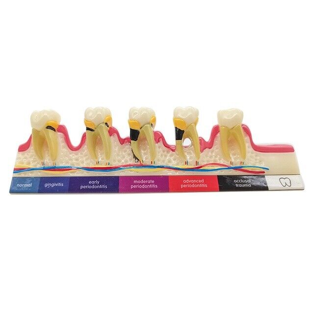 Dental Periodontal Disease Assort Demo Teeth Model Caries Teeth Model