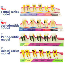 Dental Periodontal Disease Assort Demo Teeth Model Caries Teeth Model picture