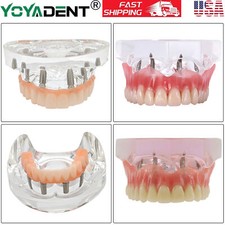US Dental Teeth Model Overdenture Inferior Implants Demo Upper/Lower Detachable picture